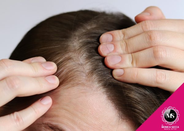 Trattamento Tricoblading Monica Secca