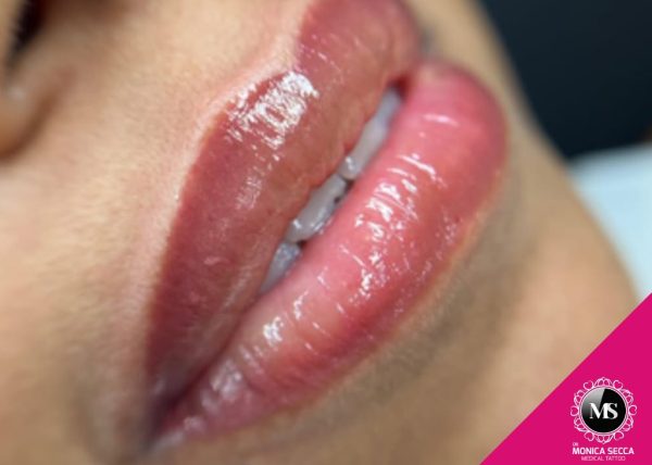 Schiaritura Labbra Scura